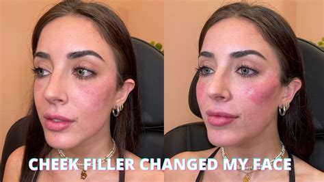 Juvederm Cheeks Before And After Photos