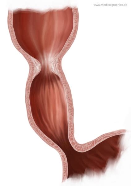 Free Illustration Esophageal stricture