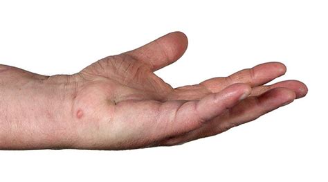 A lump in the hand | The BMJ