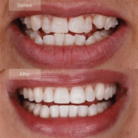 Teeth Straightening – Invisalign or Braces? - SavingSmiles