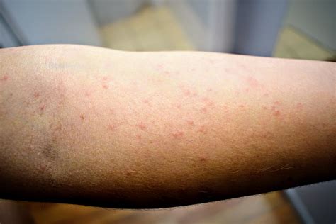 What Do Scabies Look Like On Human Skin | Images and Photos finder