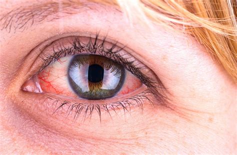 Uveitis: Causes, symptoms and treatment - IRIS