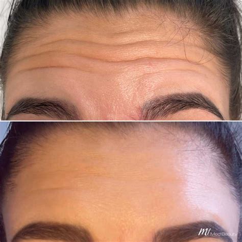 Forehead Lines Anti-Wrinkle Treatment – M1 Med Beauty Australia