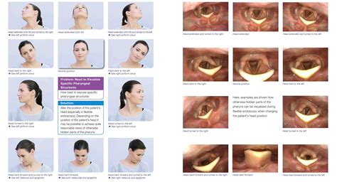 Office-Based Laryngoscopy Good Practicing Laryngoscopy Part3 - Olympus ...