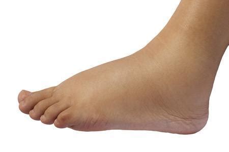 Foot Ankle Swelling Causes