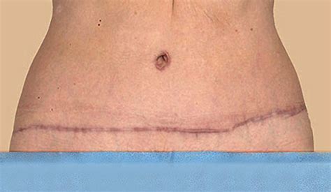 Tummy Tuck Scar: Healing, Treatment & Revision