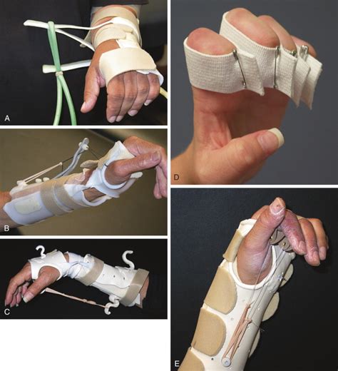 Rehabilitation of Distal Radius Fractures | Musculoskeletal Key