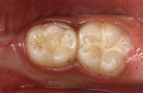 Glass Ionomer Cements for Primary Teeth - Pediatric Dentistry