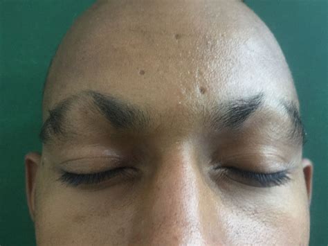 Alopecia Areata Eyebrows