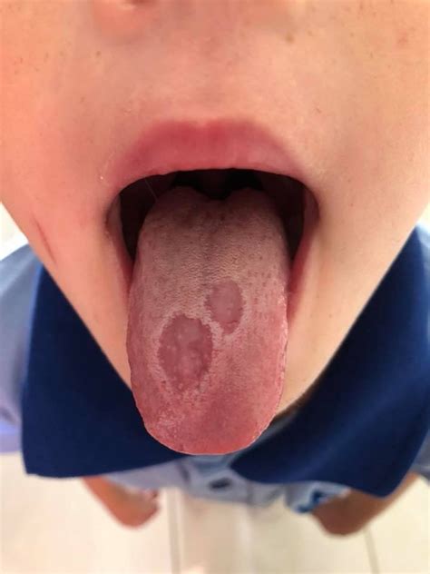 Help! What is Geographic Tongue and Do I Have it?