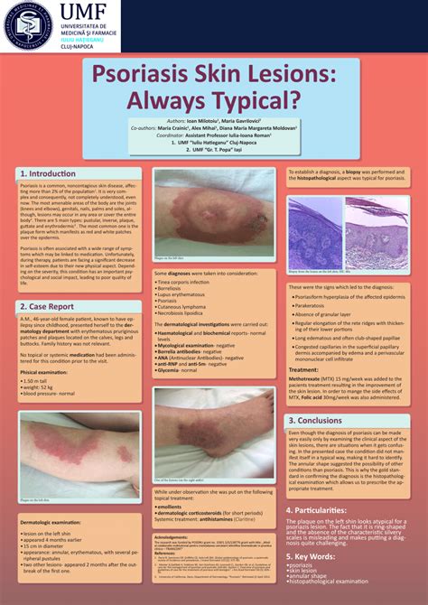 (PDF) Psoriasis Skin Lesions: Always Typical?