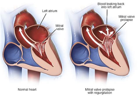 Mitral Valve Prolapse - Causes, Symptoms, Diagnosis, Treatment