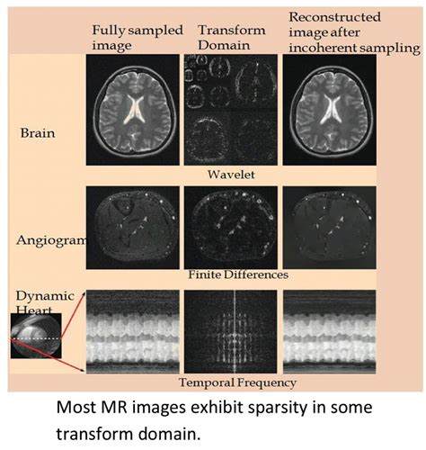 Compressed Sensing for Rapid MRI: Need for Speed | | LATEST BIOMEDICAL ...