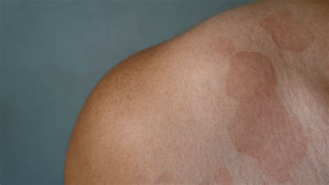 What are Welts (Skin Rash)? : Causes, Treatment, Home Remedies | Clinikally