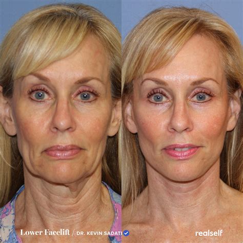 Lower Facelift vs. Neck Lift: What’s the Difference? in 2024 | Lower ...