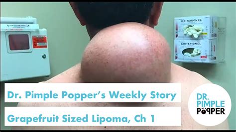 Dr. Pimple Popper's Weekly Story: Grapefruit Sized Lipoma, Chapter 1 ...