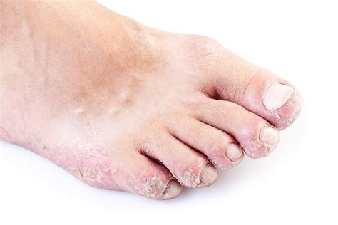 Eczema (Atopic Dermatitis) - Symptoms, Causes, Treatment and Photos