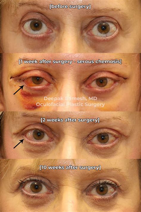 Chemosis New Jersey | The Center for Eye & Facial Plastic Surgery