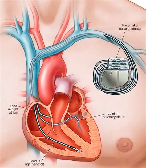 Pacemaker - Heart Pacemaker Indications, How a Pacemaker Work