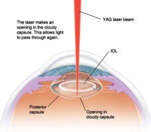 Yag Laser Eye Surgery | Yag Laser Capsulotomy - Snead Eye Group