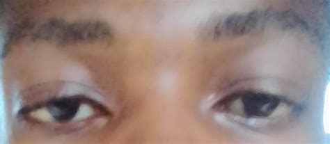 My Skin Is Getting Bad and discoloured.Advice Needed(photos) - Family ...