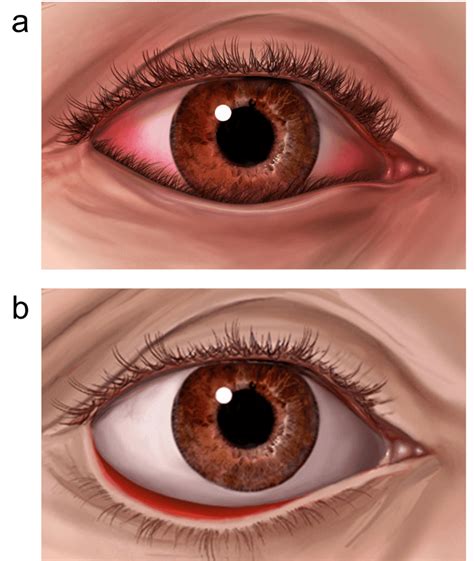 Entropion and ectropion repair | healthdirect