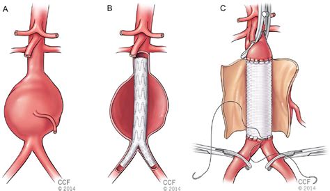 Abdominal Aortic Aneurysm Repair