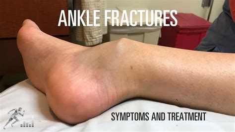 Different Types Of Ankle Fractures