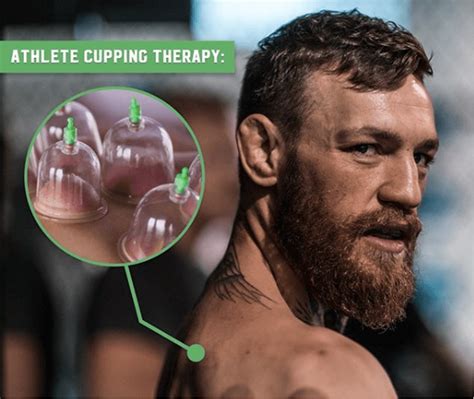 What is Cupping Therapy and What Are The Benefits - Glasgow Premier ...