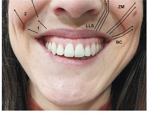 Different muscles involved during a maximum smile. The superior lip and ...