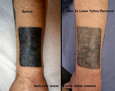 Laser Tattoo Removal No Results