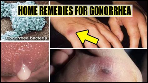 Natural home remedies for gonorrhea to cure the symptoms in men and ...