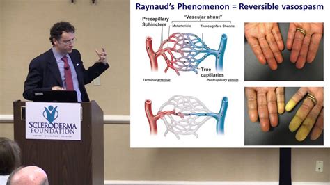 2015 Nashville- The Scleroderma Hands and Their Care- Dr. Francesco ...