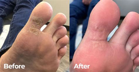 Foot Wart Removal Surgery | Bruin Blog