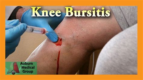 Pes Anserine Bursitis Knee Injection | Auburn Medical Group - YouTube