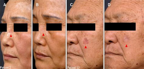 (A, B) Patient 2. (C, D) Patient 13. Clinical clearance of the actinic ...