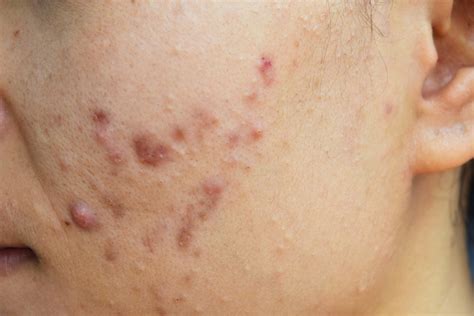 What Is Nodular Acne