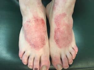 Dermatitis On Feet