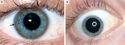 Kayser–Fleischer Rings in Wilson's Disease | NEJM