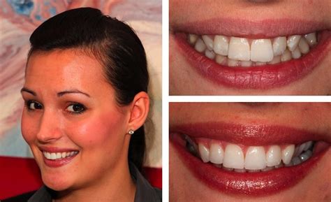 Lingual Braces Before and After – What A Transformation | Blog