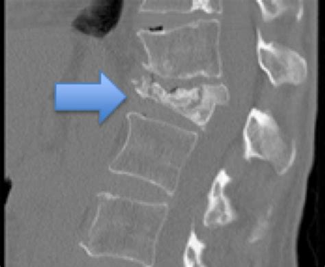 Compression Fracture Diagram