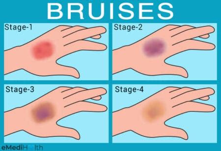 What is a Bruise or Contusion? The phases and how to treatment