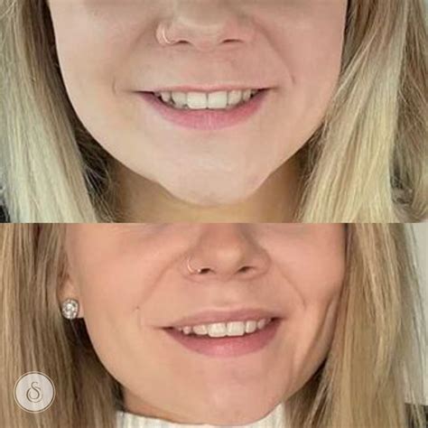 Lip Flip Botox Before And After Photos - Infoupdate.org