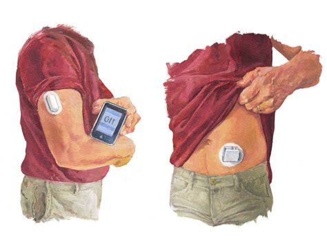 CGMs / Continuous Glucose Monitors - HERC Publishing