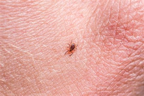 Tick-Borne Babesiosis Disease Cases Rising in Northeast, CDC Says