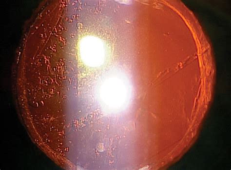 Take Charge of Cataract Care with Laser Capsulotomy