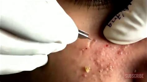 Pimple Popping Videos 2024 Blackheads Popping - Sadie Collette