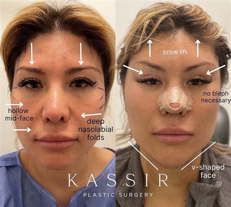 Cat Eye Facelift and Midface Lift in New York — Kassir Plastic Surgery ...