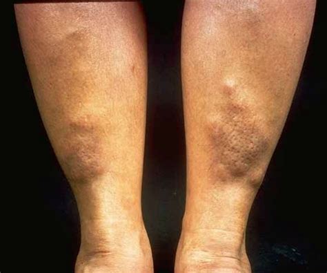 Pretibial Myxedema - Pictures, Treatment, Symptoms, Causes - HubPages