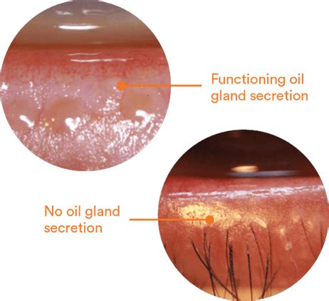 Meibomian Gland Dysfunction (MGD) – Killingly Eye Care